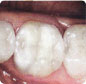 Teeth after CEREC restoration