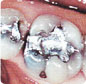 Teeth before CEREC restoration